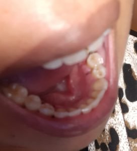 inflammation of gums around sutures in person with keloid type skin