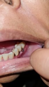 inflammation of gums around sutures in person with keloid type skin outer gums